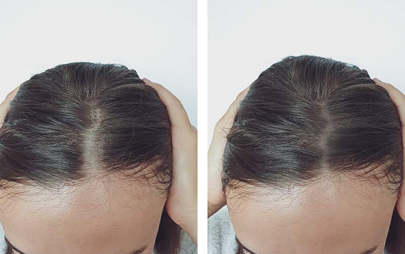 Vergleichsbild einer Frau vorher mit niedriger und nachher mit hoher Haardichte nach der PRP Behandlung