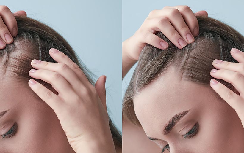 Vergleichsbild einer Frau im Vorher Nachher Vergleich am Haaransatz